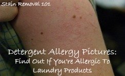 detergent allergy pictures