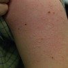 detergent allergic reaction, hives