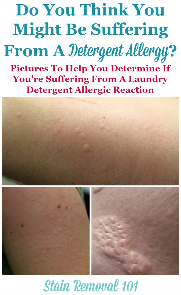 Detergent allergy pictures, to help you determine if you've got an allergic reaction to laundry products {on Stain Removal 101}