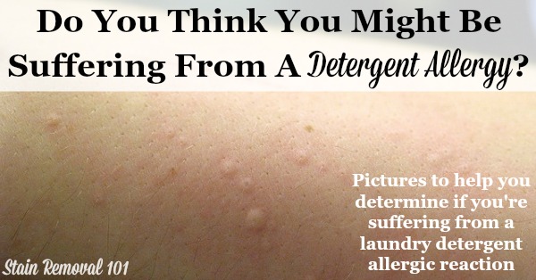 Detergent allergy pictures, to help you determine if you've got an allergic reaction to laundry products {on Stain Removal 101} Detergent allergy pictures, to help you determine if you've got an allergic reaction to laundry products {on Stain Removal 101}