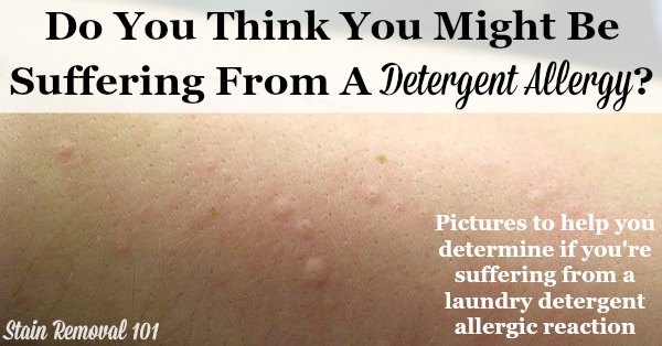 Detergent allergy pictures, to help you determine if you've got an allergic reaction to laundry products {on Stain Removal 101}