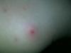 Possible Reaction To Laundry Detergent