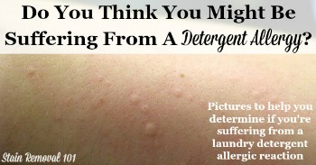 Do you think you might be suffering from a detergent allergy? Pictures to help you tell.